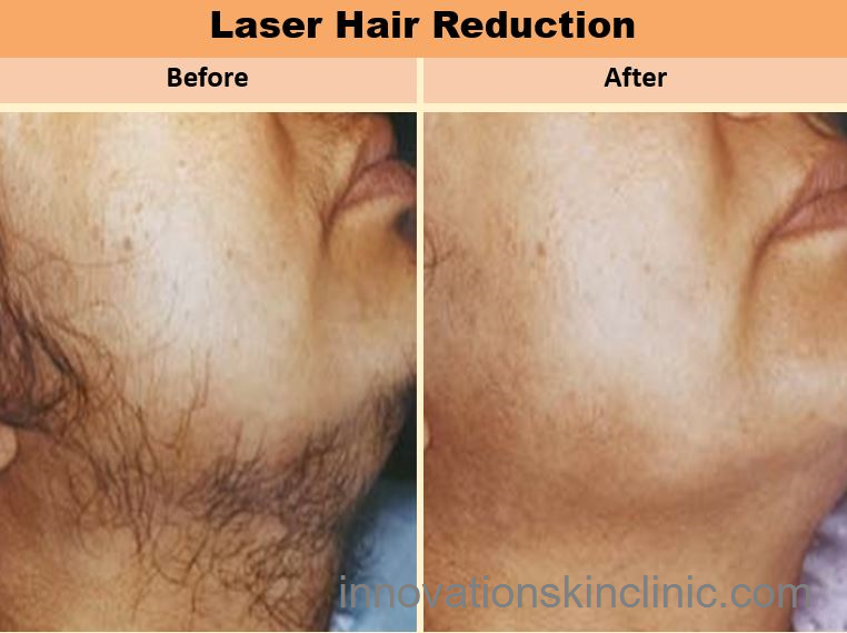 Laser Hair Removal 1